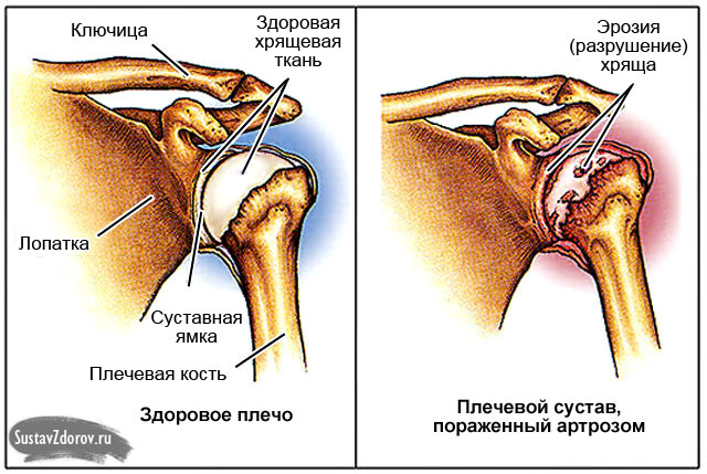 Muutused liigestes artriidi Ravi harja kaed artroosi ajal