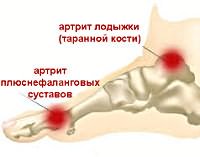 Vaikeste liigendite artriit jalgsi