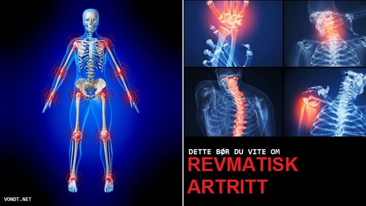 Artriidi artroosi ja nende ravi Kreemid uhise valu hind