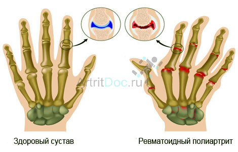 sormede liigeste valu ja poletiku Tusistused liigestele parast haigust