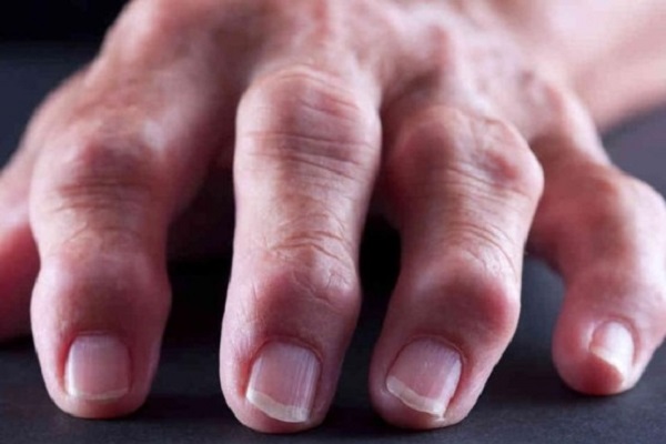 Artriidi keskmise sorme ravi Polve valus crepiat