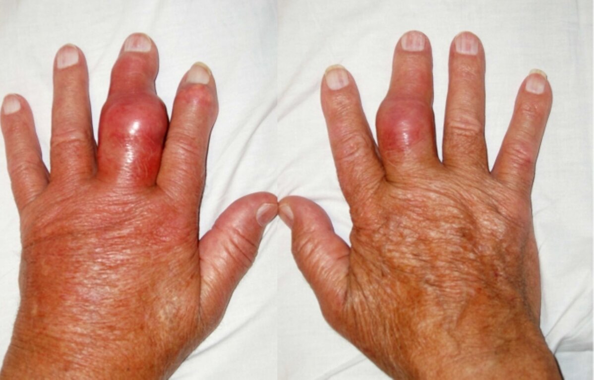 kuunarnuki liigese nakkuslik artriit