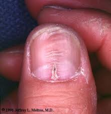 Rampide seente ravi Hoidke liigeseid kaja sormede