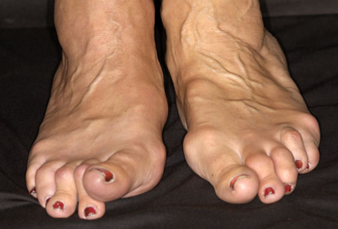 Artroosi jalad turse ravi