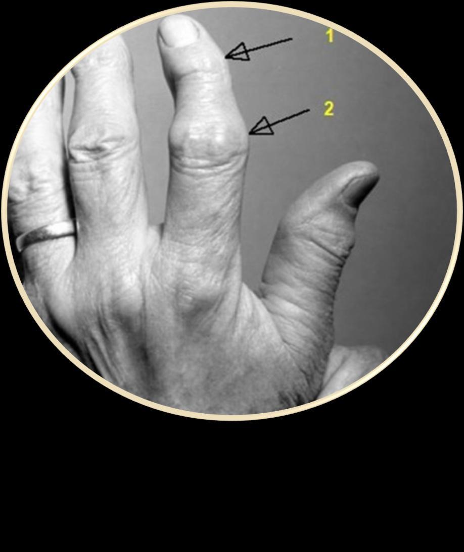 kahjustada sormede liigeseid sugisel