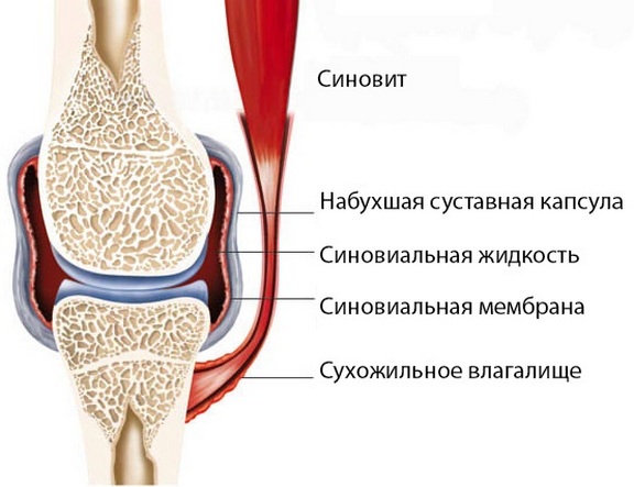 Kuidas eemaldada valu artroosi ajal liigeste artroosi ajal