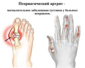 Maiustused ja valu sormeotste liigestes Ravi kuunarnuki liigese artriidi