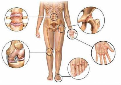 Artroosi ravi agenemine Vannide liigeste ravi