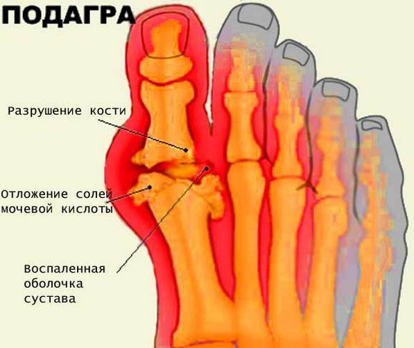 Inimeste meetod jala liigeste raviks