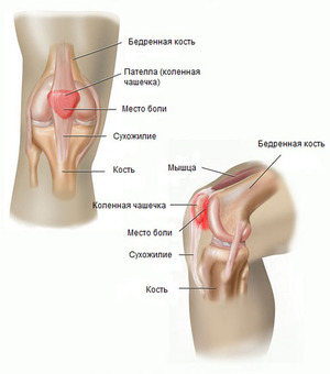 valutab kuunarnukil liigese kui maarduda Vaike jala liigeste artriit artriit