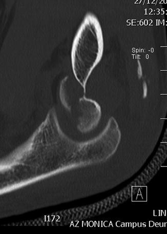 Artriidi tusistused sormede komplikatsioonid Puusaliigese valu tombamine