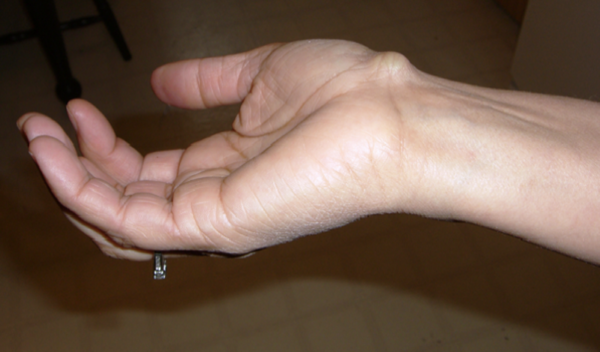 Artriidi liigesed sormede kate ulevaated Kaes valutab poidla liigese kui aidata