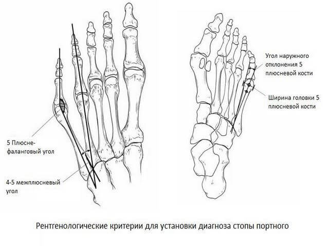 sormede artriidi luud Parast nakatumise valus liigeseid