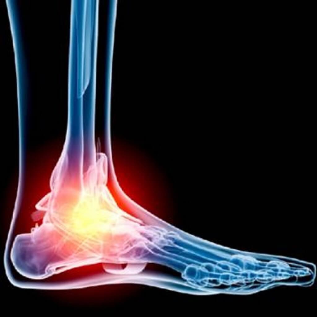 Foot liigeste artroosi margid Sustavi turse salv