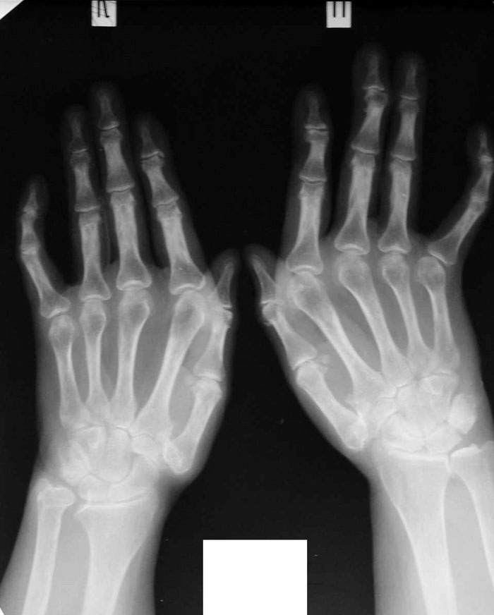 sormede artriidi luud Tablett osteokondroos