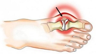 Jalgade liigeste artriit ja artroos Teadus liigeste ravi kohta
