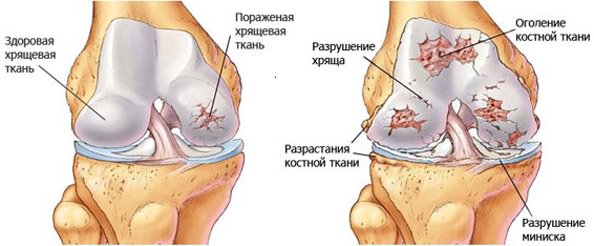Salv jala liigeste artroosist Balm taastab kreemi liigestele