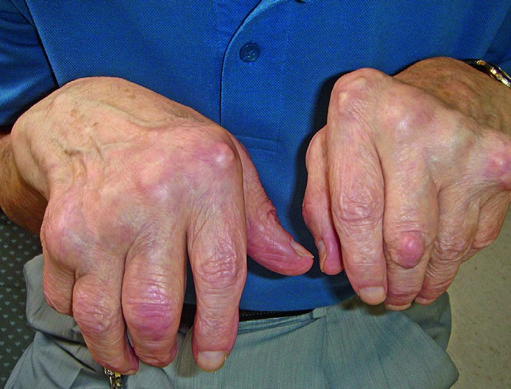 Liigeste loengu haigused Mida maardeliigese artroosi maarduda