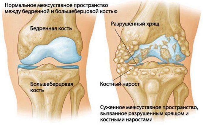 Keskmise liigese jala artroos Uhine kahjuliigid