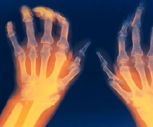 artriit ja artroos nende ravi