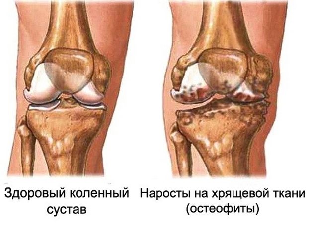 Kasi tuimus artriidi haiget jala liigesed ja luud