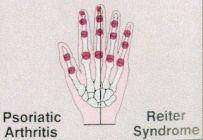 Artriit Phalange sormed seljavalu liigestes