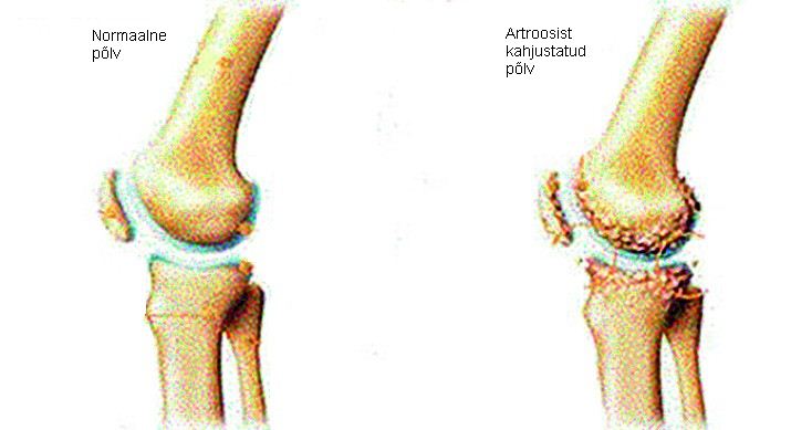 Kaela kaar-sunnitud liigeste artroos Milliseid tunnete kui liigeste haige