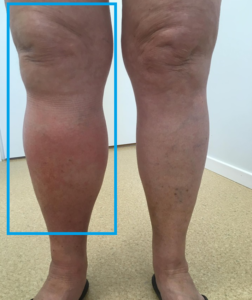 Liigeste ja jalgade turse Artriidi haavandid liigestele
