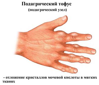Liigeste tootlemine vastavalt MalySheva meetodile Artriidi ja artrohi ravi valismaal