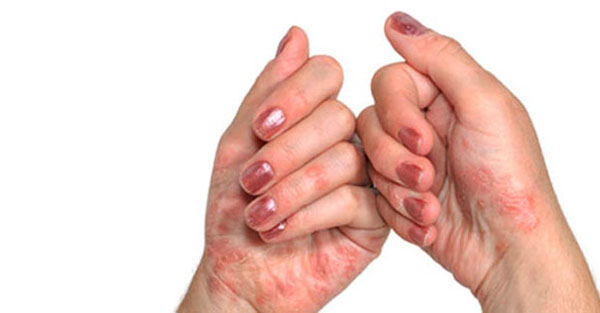 Mida artriit sormedel tekivad