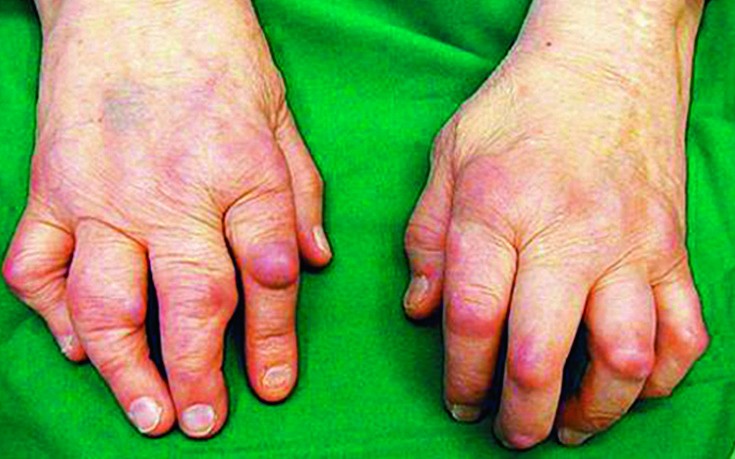 Mis ravida artriit jalgadel Eemaldage valu tableti liigestes