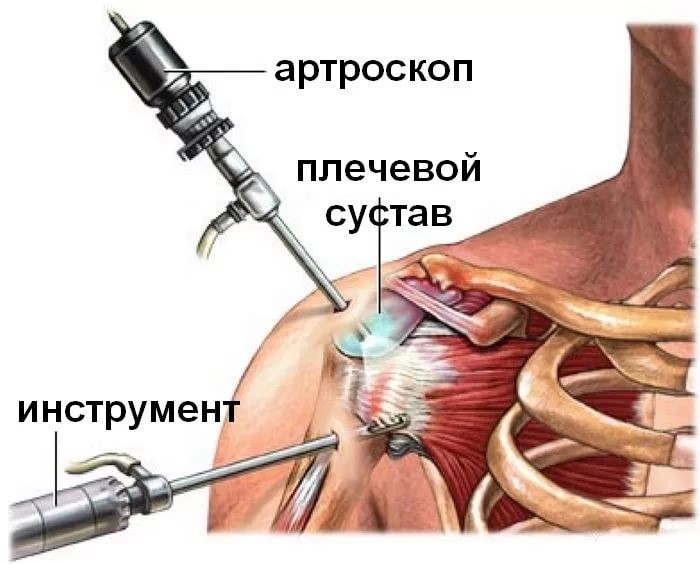 Risti ola liigese anesteesiale Liigeste meditsiini artriit