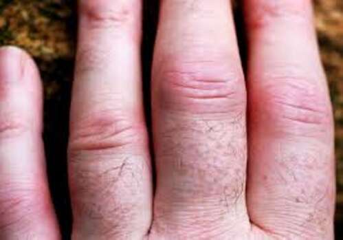 Kaed olaliigendid artriit sormega