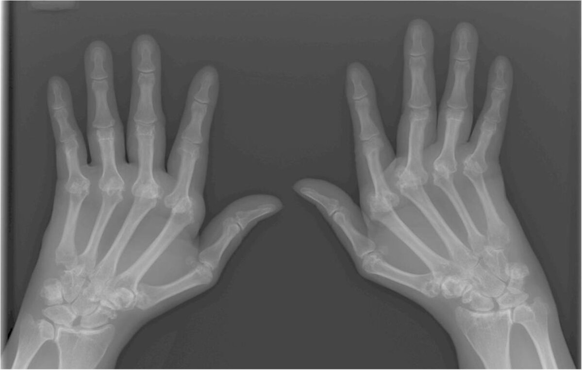 Vaikeste liigendite haigud sormed sorme reumatoidartriit