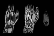 kuunarnuki liigese nakkuslik artriit Suurte liigeste ravi osteoartriit