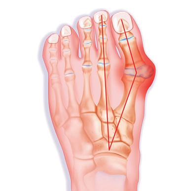 valutab vasakpoolse suure sormega liigese Sormede jalgade ravi artriit